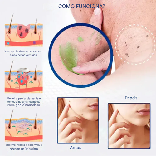 Elycura™ NatureErase: Elimine Marcas Indesejadas em 7 Dias Sem Cirurgia, Sem Dor. (Somente HOJE!)🔥 - Imagem 4